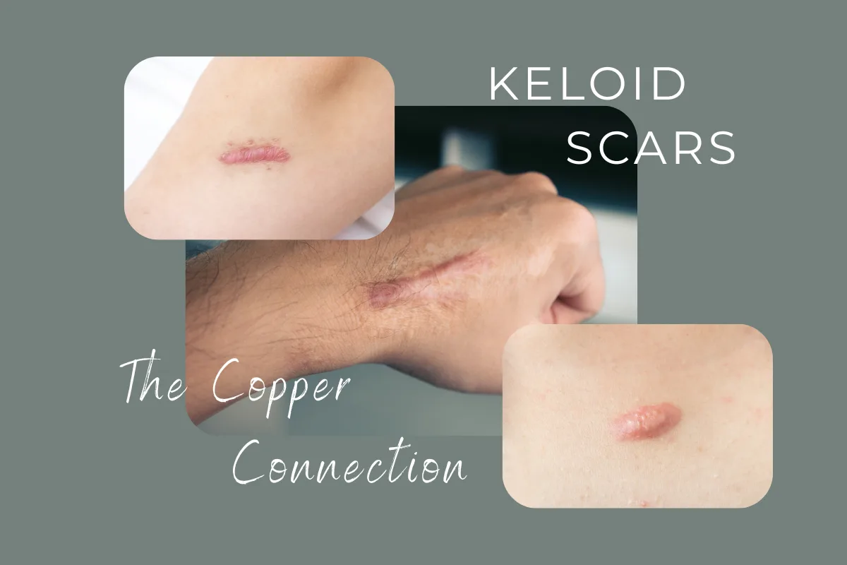 keloids